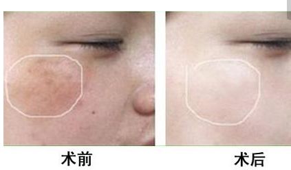 長沙美田芳斌雙眼皮讓你驚艷！令人難忘的改變來襲！