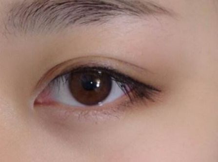 杭州任東做鼻部整容效果如何？MD技術(shù)解析真實(shí)案例分享！