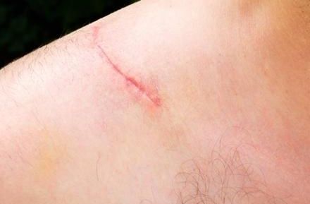 八大處張超面部吸脂效果解析：醫(yī)生技術(shù)實(shí)力、案例與價(jià)格