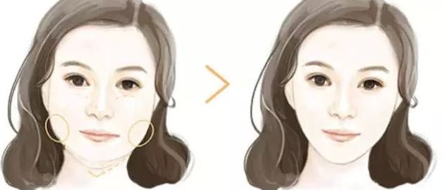 北京黎星醫(yī)生的面部脂肪填充效果如何？真實(shí)案例揭秘！