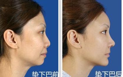上海九院鼻部整形手術(shù)專家李圣利，專業(yè)水準(zhǔn)如何？