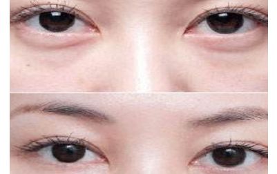 北京張笑天的下頜角手術(shù)技術(shù)及豐碩成果曝光！醫(yī)術(shù)精湛，案例展示震撼人心