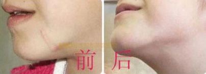 上海哪家醫(yī)院有專業(yè)的唇裂手術(shù)醫(yī)生？治療兔唇患者的必備信息！