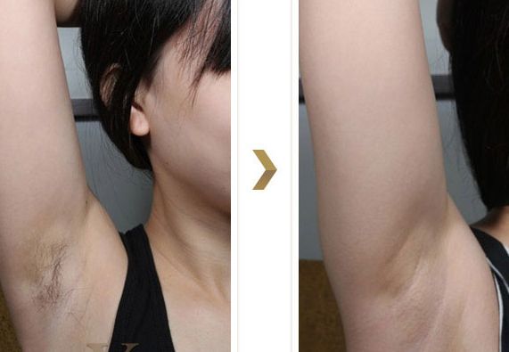 長沙湘雅醫(yī)院的減肥科如何？大腿吸脂效果如何？