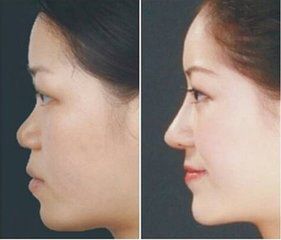 成都邱偉醫(yī)生雙眼皮術的成功案例分享 成都邱偉醫(yī)生雙眼皮術的成功案例分享
