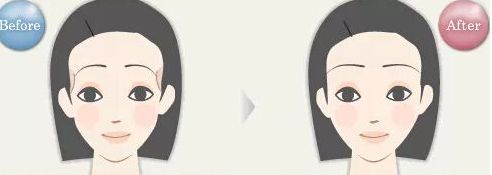揭密石家莊哪位雙眼皮醫(yī)生備受關注，優(yōu)點揭秘，價格參考！