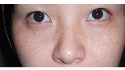 張恒術(shù)雙眼皮手術(shù)80天后效果揭曉，驚喜呈現(xiàn)！