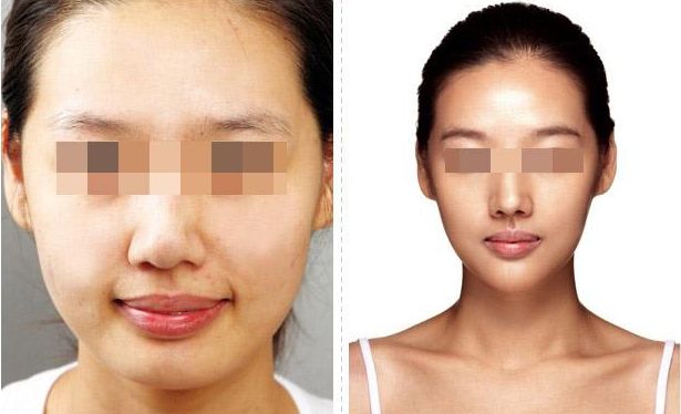 武漢恩娜整形中心：解讀雙眼皮手術(shù)全攻略，案例展示讓你真實了解效果！