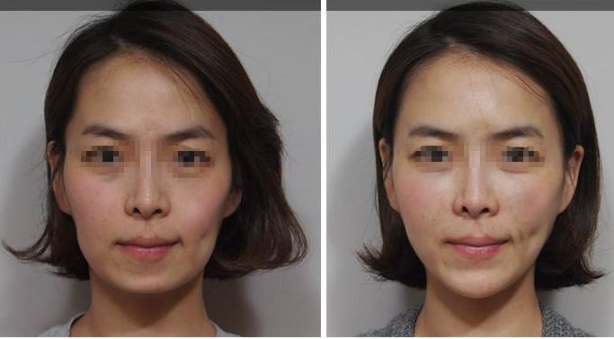 深圳頂級乳房整形專家團隊？權威醫(yī)院解答哪家三甲醫(yī)院最適合隆胸