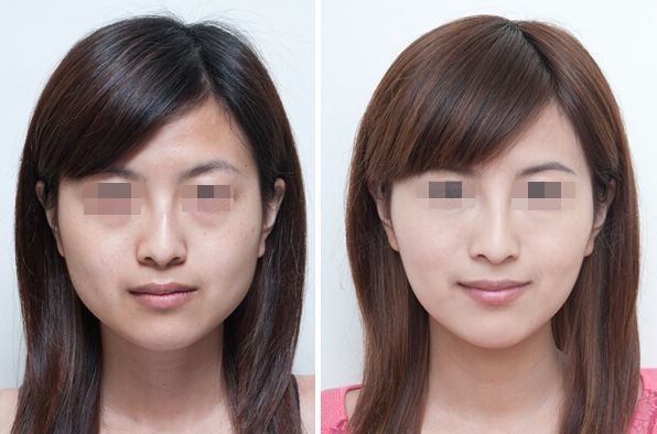 鄭州假體隆胸：哪家醫(yī)院在同類榜單有亮眼表現(xiàn)？