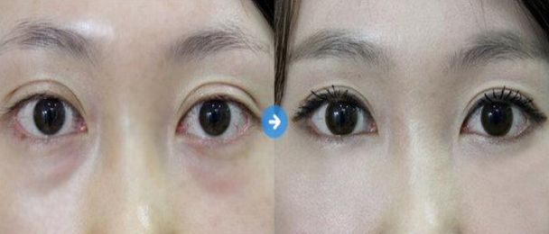盤點(diǎn)北京7大值得信賴的開眼角整形醫(yī)生 盤點(diǎn)北京7大值得信賴的開眼角整形醫(yī)生