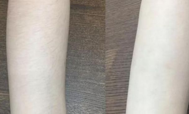 宜賓第一人民醫(yī)院的無痛隆鼻案例分享及費用公示 宜賓第一人民醫(yī)院的無痛隆鼻案例分享及費用公示