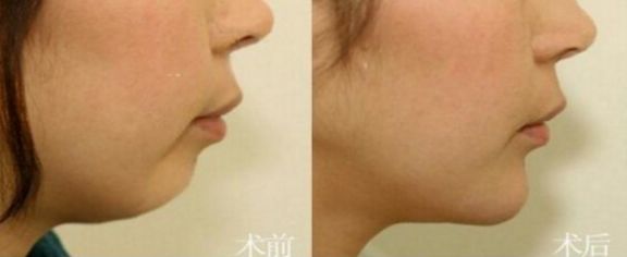 成都這7家專(zhuān)業(yè)豐胸醫(yī)院，不可錯(cuò)過(guò)的排名第一