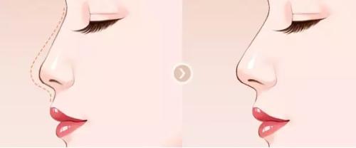 寧波韓美整形吸脂值得信賴嗎？