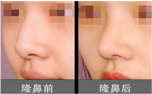 上海柴云醫(yī)生雙眼整形效果完美！手術(shù)前后真實(shí)照片呈現(xiàn)出專業(yè)水平