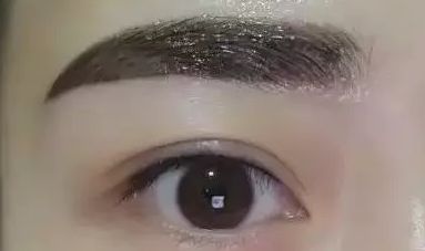 浙二醫(yī)院葉娟為患者打造完美雙眼皮，成就精致美眸