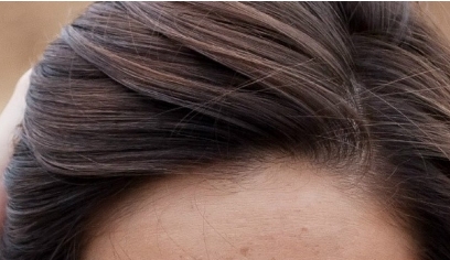 南昌二附院整形科眼袋抽脂效果好嗎？值得醫(yī)生推薦嗎？