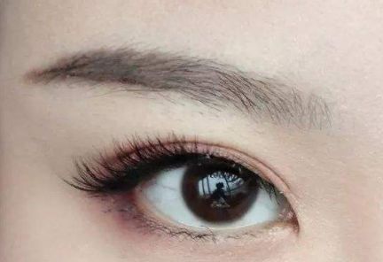 大連王琳雙眼皮的完美實(shí)踐，80天親身體驗(yàn)揭秘
