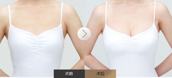 全面了解雙眼皮手術(shù)，揭秘風(fēng)險與安全