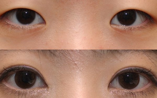 上海哪家醫(yī)院做眼袋手術(shù)價格實惠又靠譜？排行榜前十強(qiáng)！
