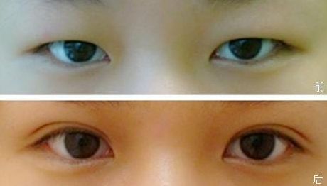 塑造完美鼻型，一觸即達！隆鼻醫(yī)生品牌推薦，成功案例揭秘，費用一覽表震撼來襲