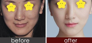 有效消腫的雙眼皮修復技巧由經(jīng)驗豐富的整形醫(yī)生分享 有效消腫的雙眼皮修復技巧由經(jīng)驗豐富的整形醫(yī)生分享