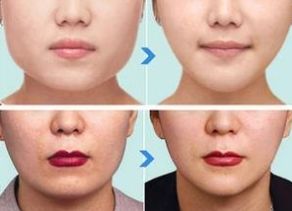 杭州哪家醫(yī)院做下頜角整形效果好？綜合口碑、價(jià)格受好評(píng)的幾家醫(yī)院推薦