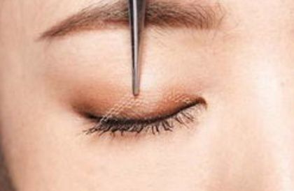 鄭州賈亮眼部整形技術(shù)介紹，修復雙眼皮效果如何？成功案例披露