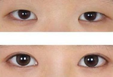 揚(yáng)州陳嘯醫(yī)生的雙眼皮手術(shù)功力與成功案例分享 揚(yáng)州陳嘯醫(yī)生的雙眼皮手術(shù)功力與成功案例分享