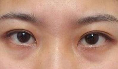 杭州東方整形吸脂到底值不值得嘗試？