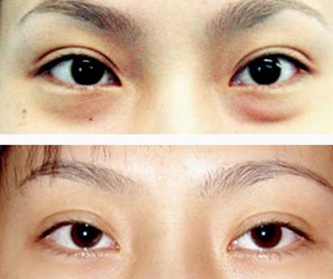 謝錦清：醫(yī)術(shù)高超，雙眼皮案例解析曝光！