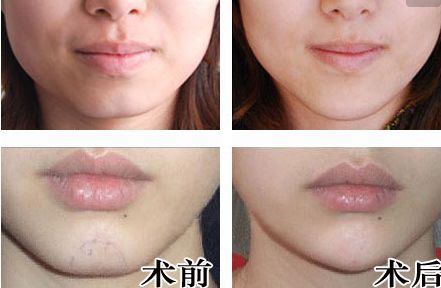 廣州人中縮短手術(shù)醫(yī)生推薦？網(wǎng)友真實(shí)評(píng)價(jià)與信息公開！