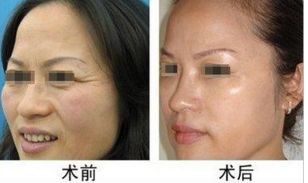 常見需要整形的手術嘴唇類型