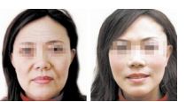 上海九院植發(fā)醫(yī)生口碑榜，收費(fèi)價格表公開