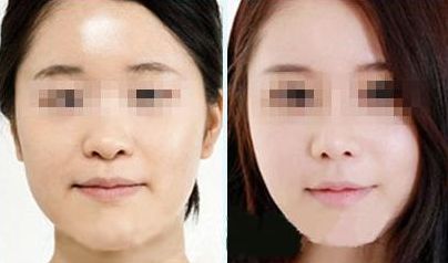 優(yōu)質(zhì)修復妊娠紋服務(wù)中心推薦