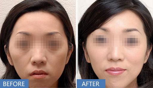 上海哪家醫(yī)院做打玻尿酸除皺效果好？