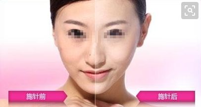 廣州哪家醫(yī)院可以安全進(jìn)行拉皮手術(shù)？