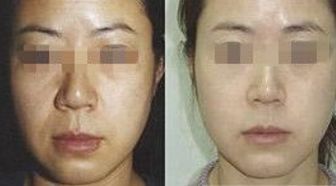 王自謙脂肪移植，存活率高受追捧