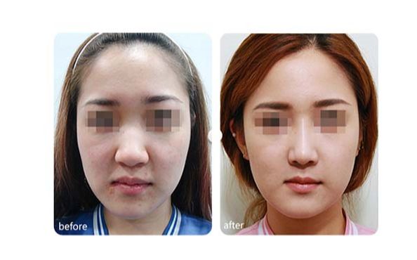 廣州隆胸醫(yī)院推薦：李高峰醫(yī)生技術怎么樣？附案例價格參考~