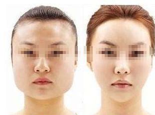 告別痘痘困擾，打造光彩肌膚