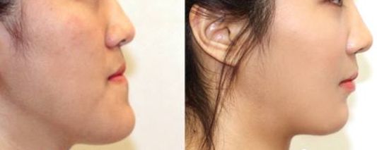 南京施爾美醫(yī)院醫(yī)生案例對(duì)比，讓你信服！