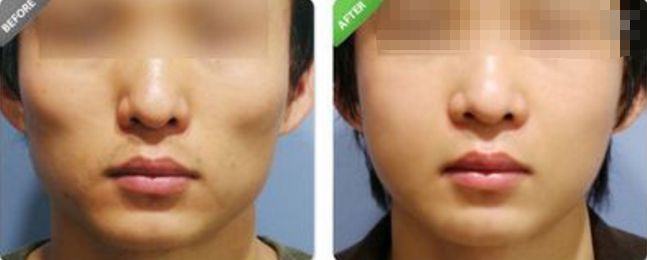 深圳哪家醫(yī)院的拉皮除皺效果最好？排名前幾位的醫(yī)院有哪些？