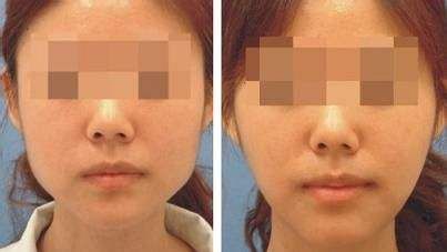 上海哪家醫(yī)院的下巴隆鼻手術(shù)效果最好？