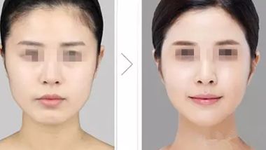 長沙雙眼皮整形醫(yī)院推薦，哪家效果更好？