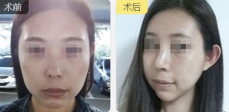 合肥雙眼皮整形推薦：口碑好、技術(shù)精湛、性價比高的醫(yī)生
