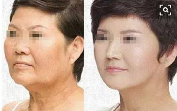西安哪家醫(yī)院可信賴進行隆鼻手術 西安哪家醫(yī)院可信賴進行隆鼻手術