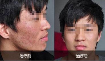 重慶吸脂哪家好？華美吸脂專家經驗豐富，安全保障