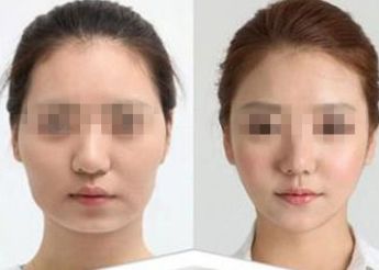 南寧市哪家醫(yī)院做雙眼皮好？