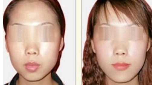 荊州哪個醫(yī)院能做隆鼻手術效果好？