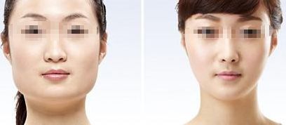 咸陽哪家醫(yī)院做雙眼皮好？醫(yī)院推薦！